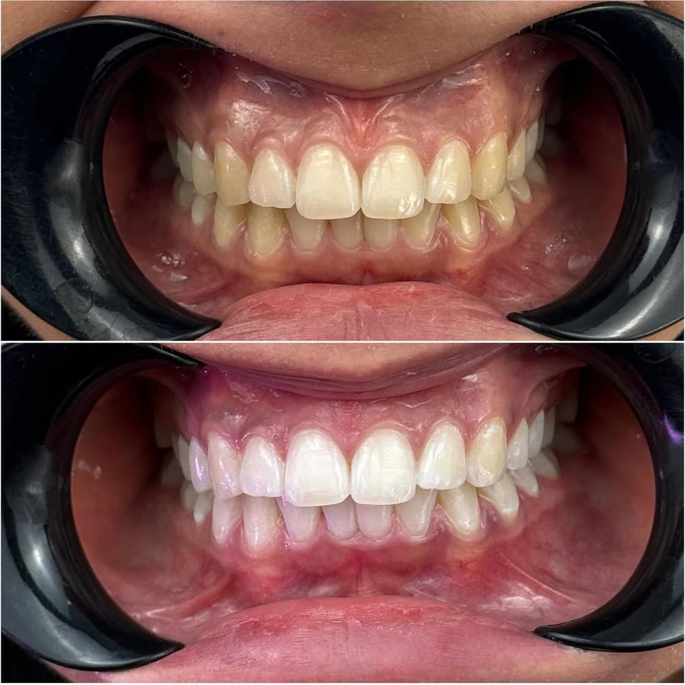 Antes y después de un caso de blanqueamiento hecho en Smile Align