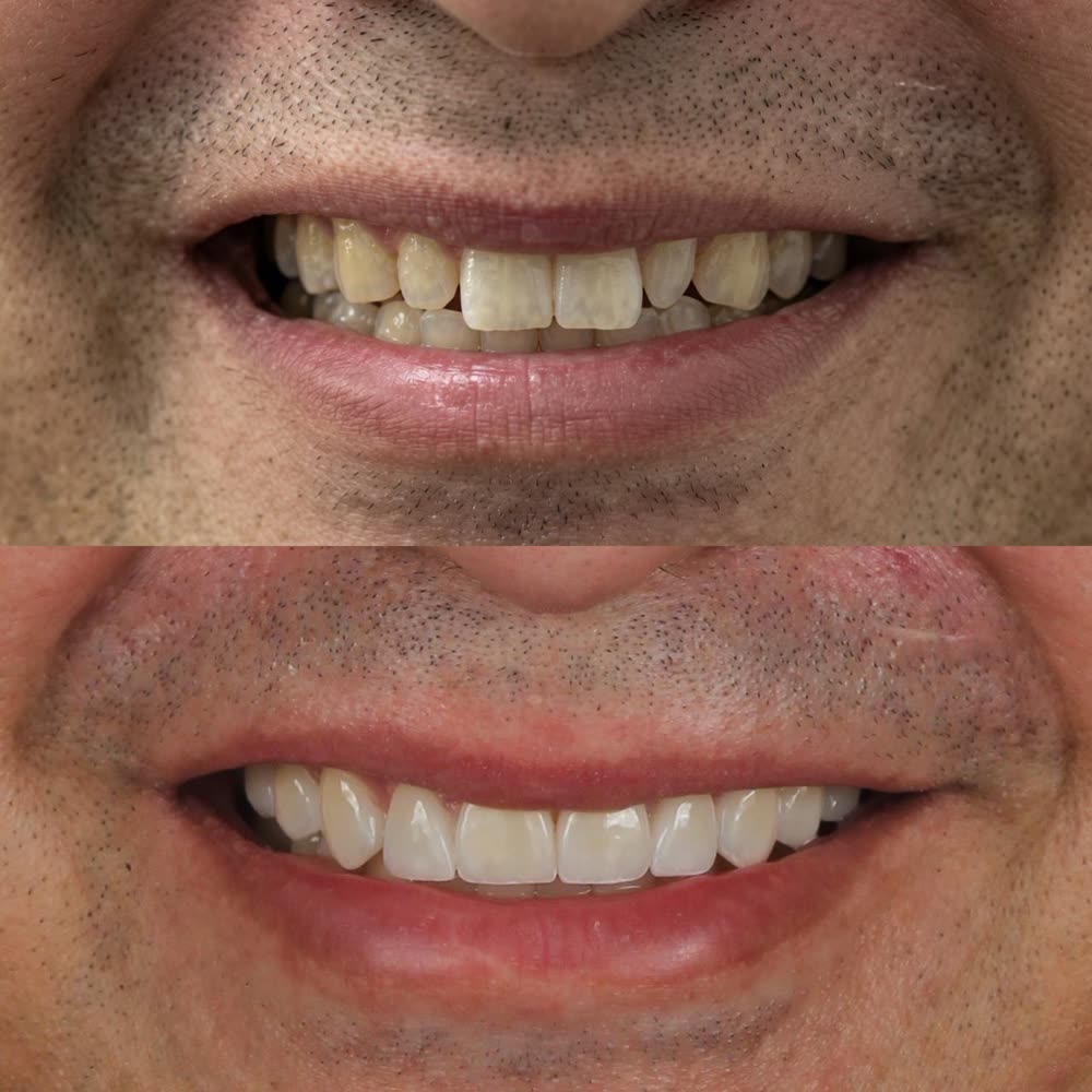 Antes y después de un caso de carillas de porcelana hecho en Smile Align