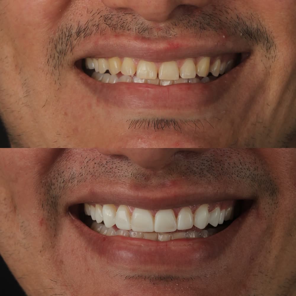 Antes y después de un caso de carillas de resina hecho en Smile Align